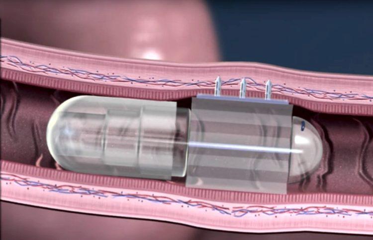 «Умная капсула» RaniPill делает безболезненные уколы внутри кишечника